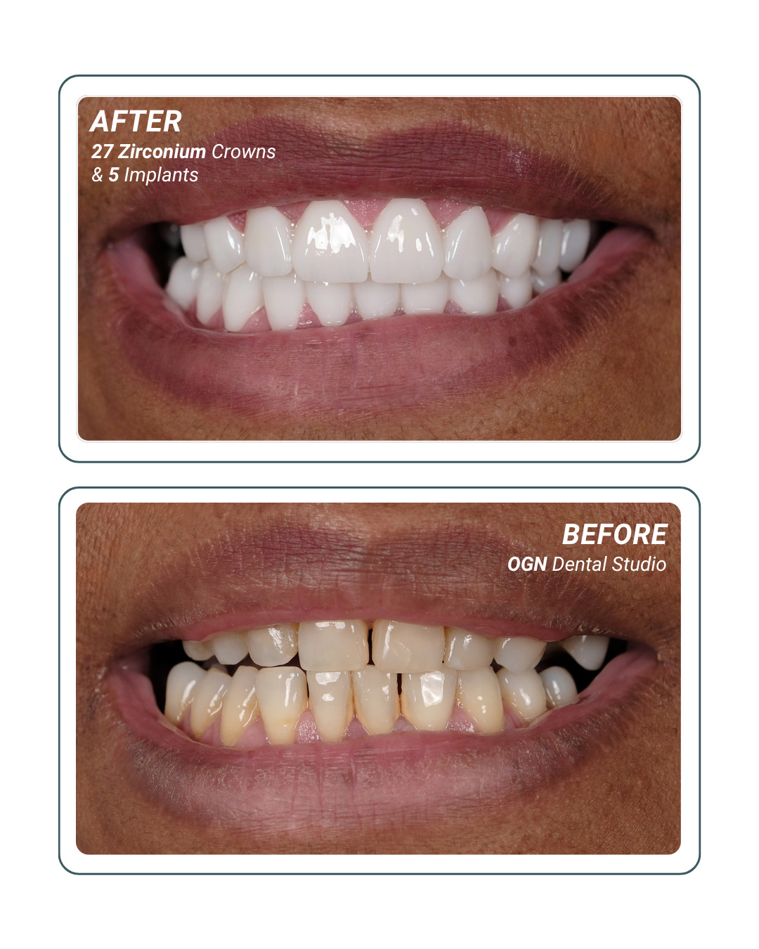 27 Zirconium Crowns and 5 Implants — before and after at OGN Dental