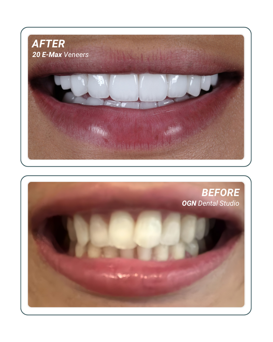 20 E-Max Veneers — before and after at OGN Dental
