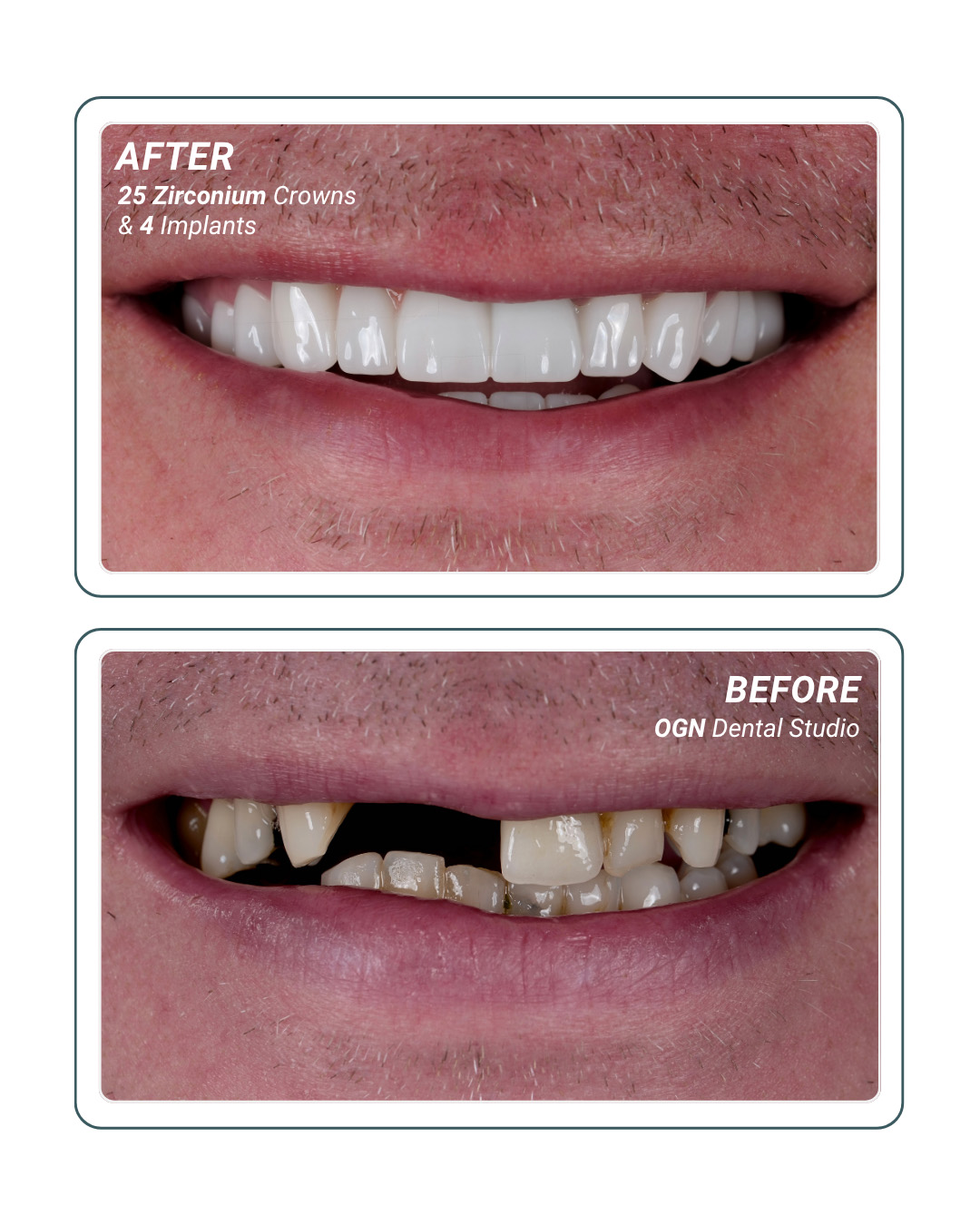 25 Zirconium Crowns and 4 Implants — before and after at OGN Dental