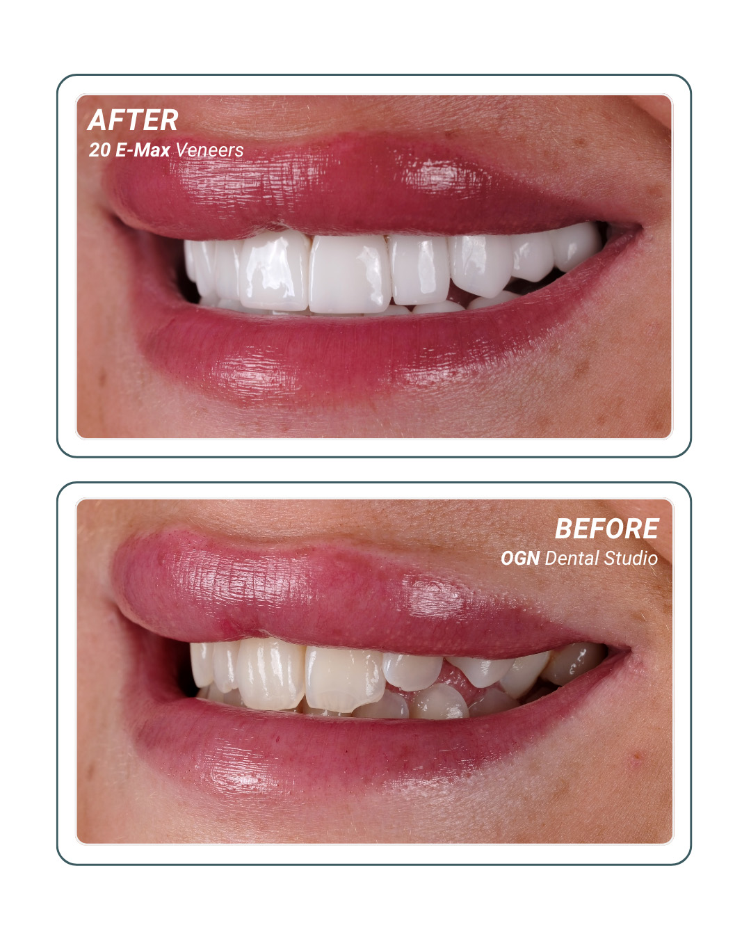 20 E-Max Veneers — before and after at OGN Dental