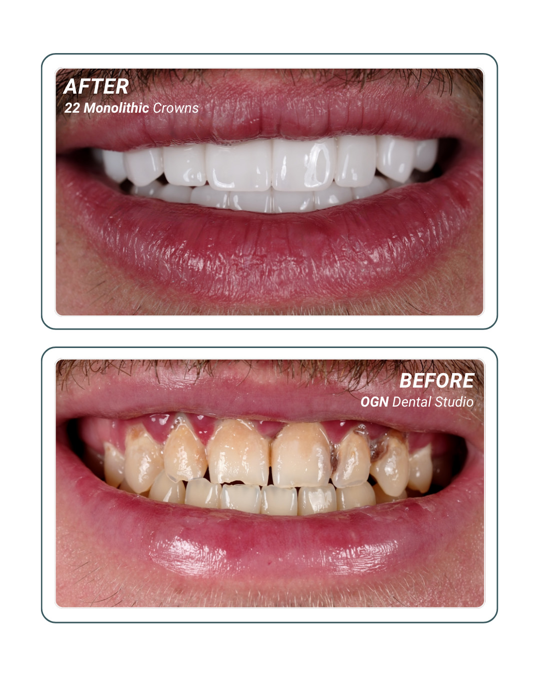 22 Monolithic Crowns — before and after at OGN Dental