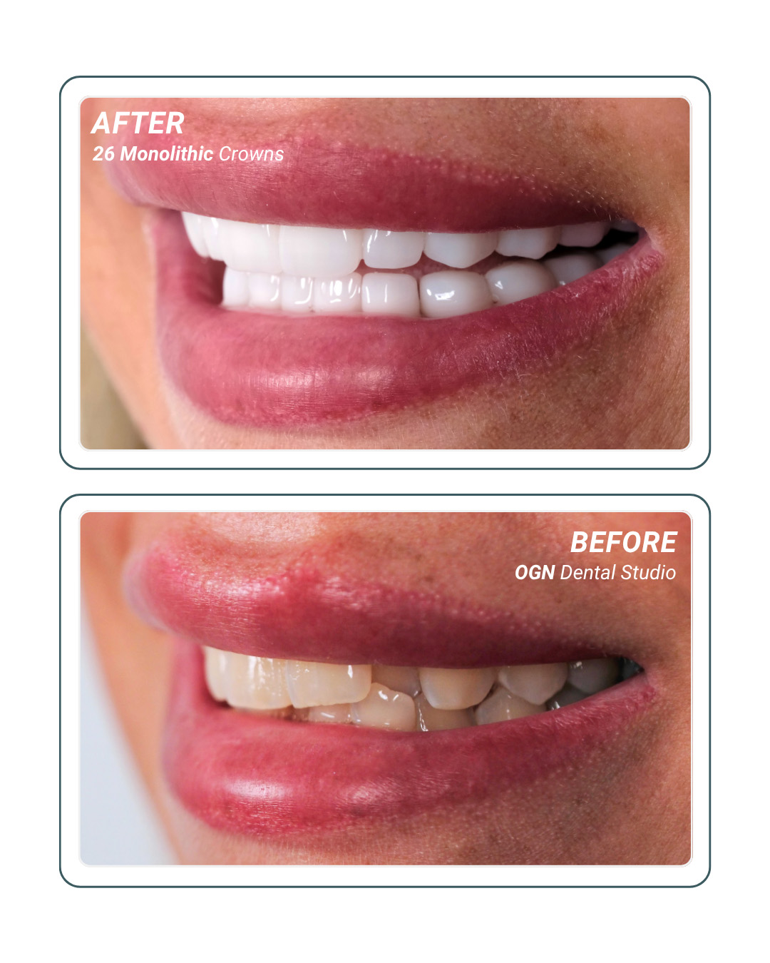 26 Monolithic Crowns — before and after at OGN Dental