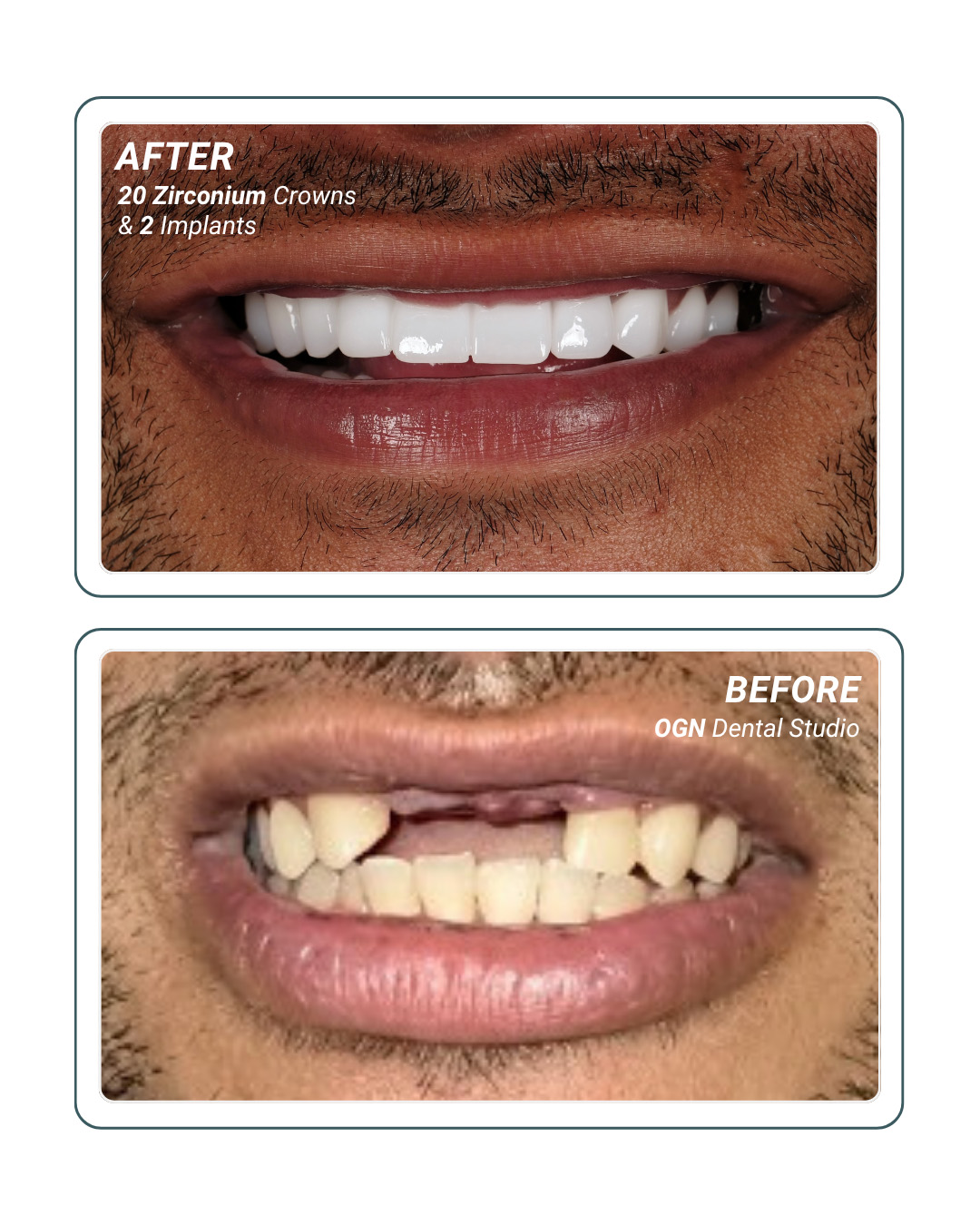 20 Zirconium Crowns and 2 Implants — before and after at OGN Dental