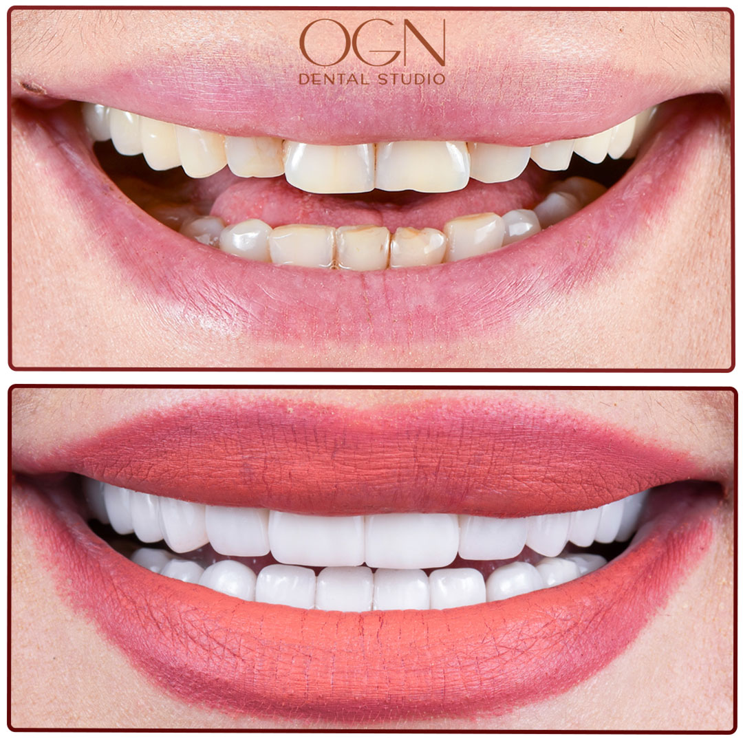 ogn dental