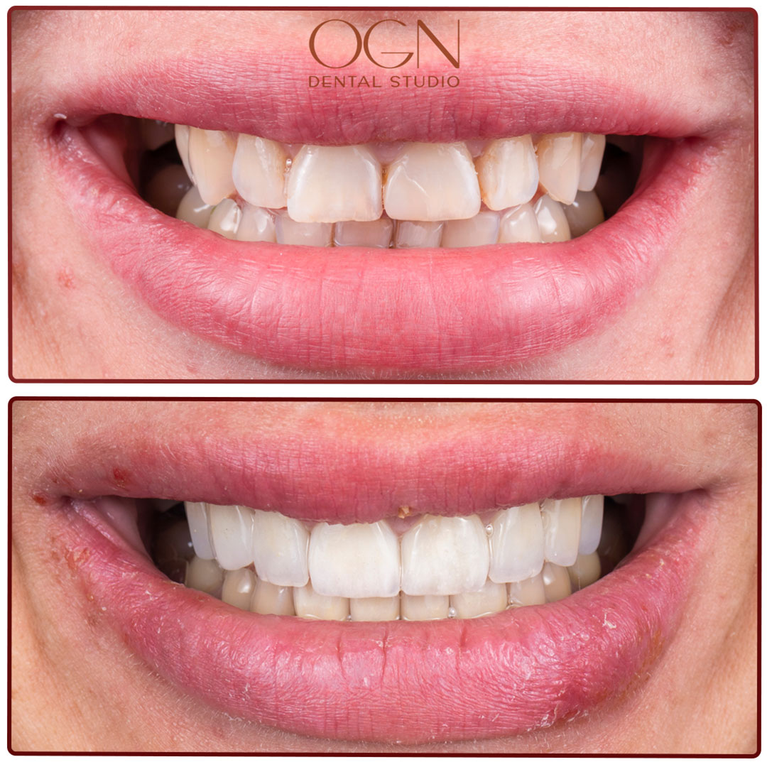 ogn dental