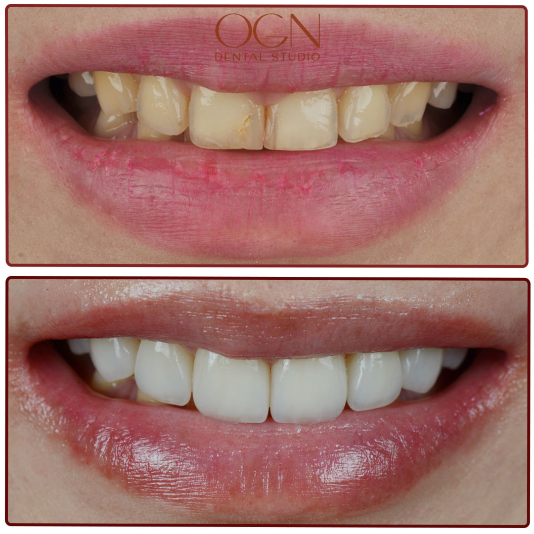 ogn dental