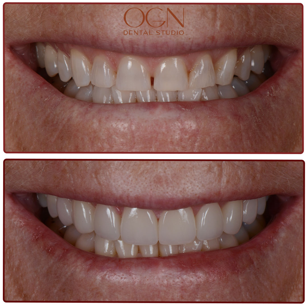 ogn dental