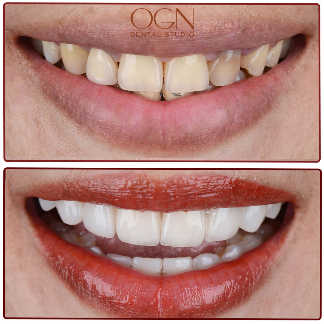 ogn dental