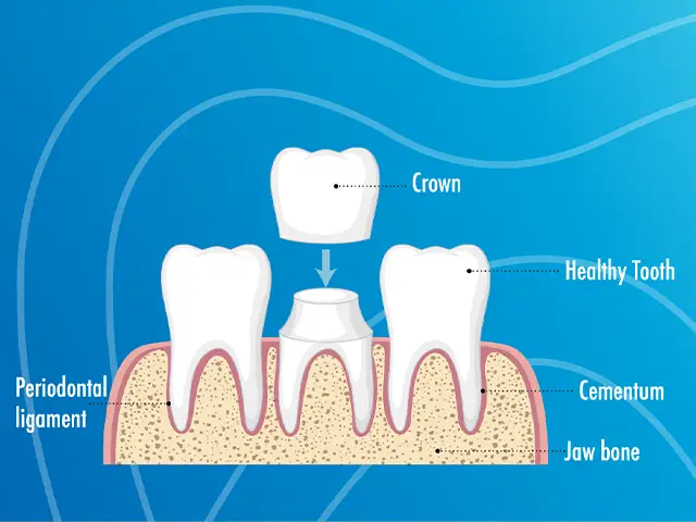 Dental Crowns 7 Dental Crowns - OGN Dental Studio ANTALYA