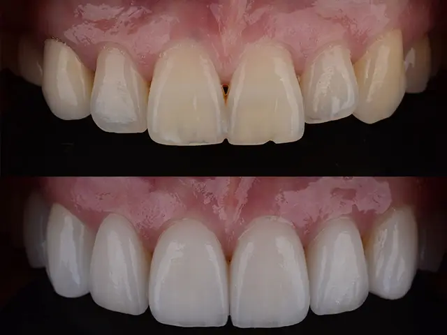 Emax Veneers 11 Emax Veneers