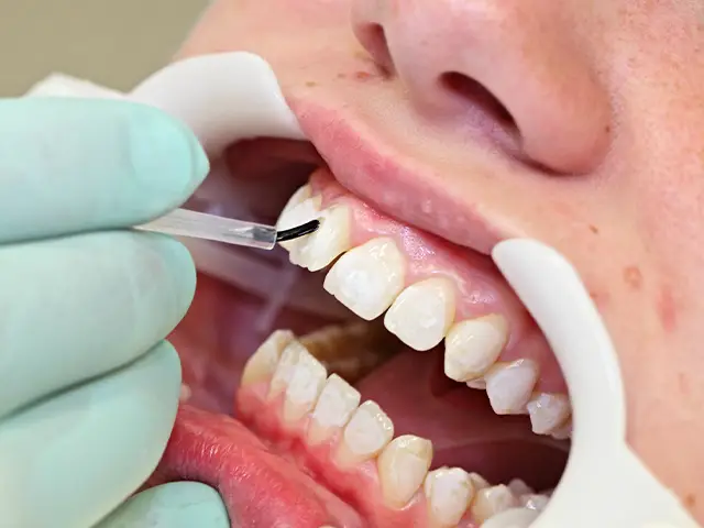 Composite Bonding 1 Composite Bonding
