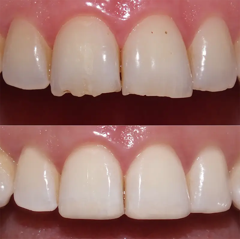 Composite Bonding 2 Composite Bonding