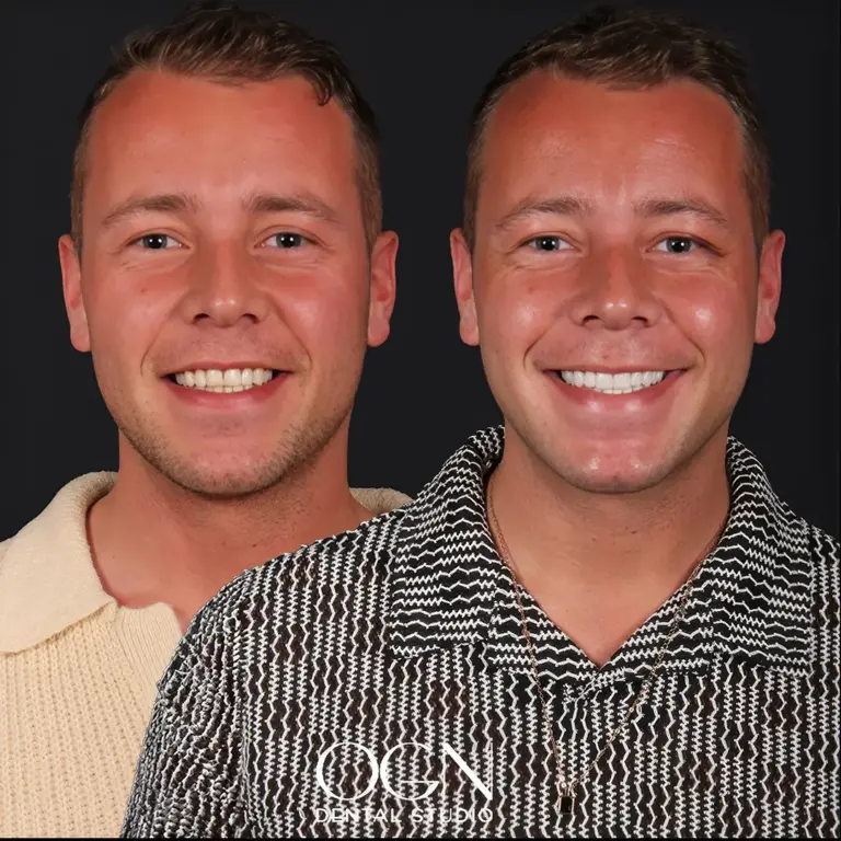 Before & After 12 Before & After - OGN Dental Studio