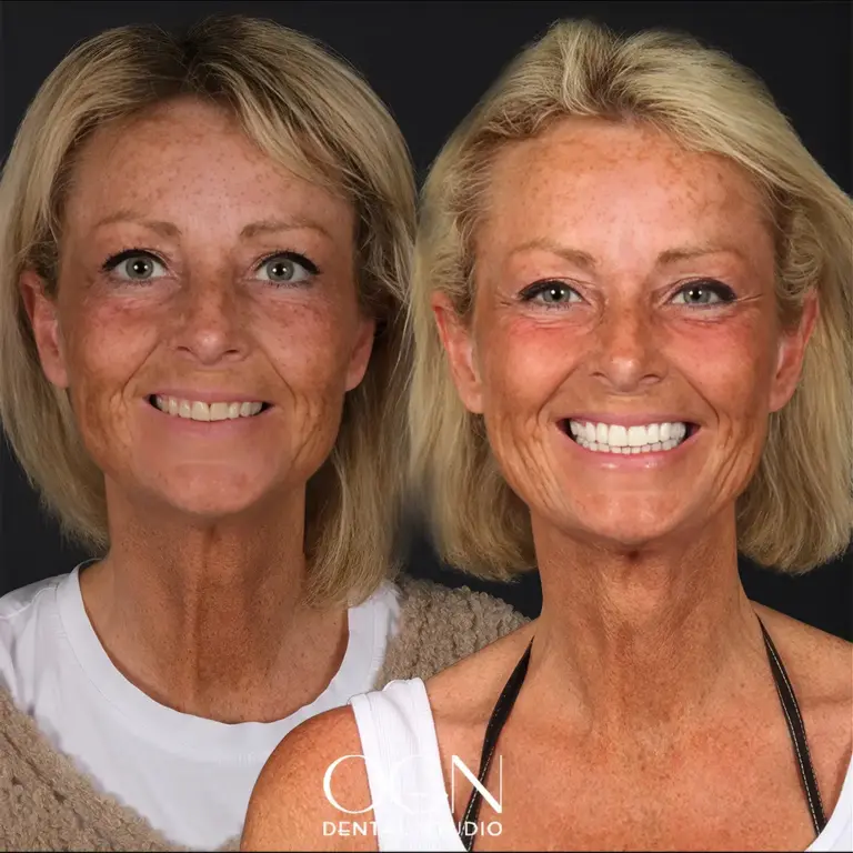 Before & After 15 Before & After - OGN Dental Studio