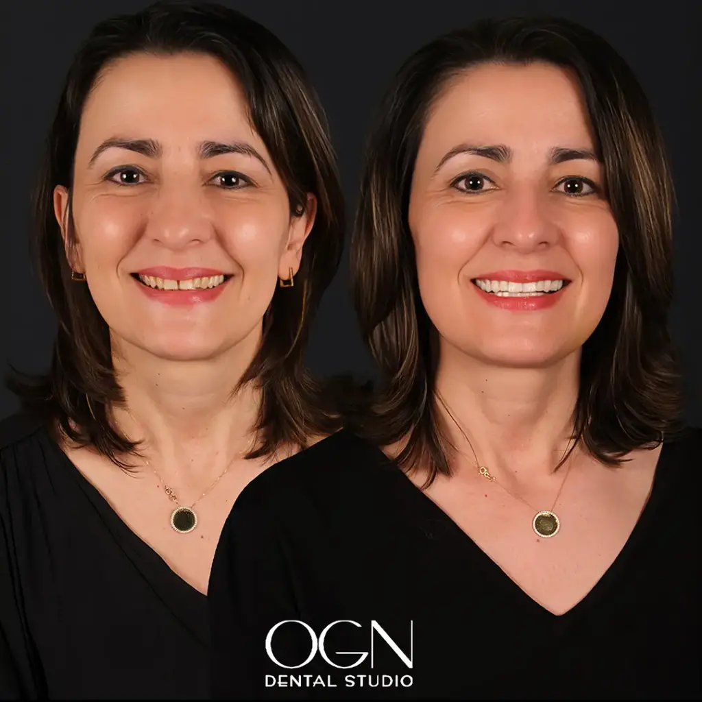 Get Teeth Done in Turkey 3 Before & After - OGN Dental Studio