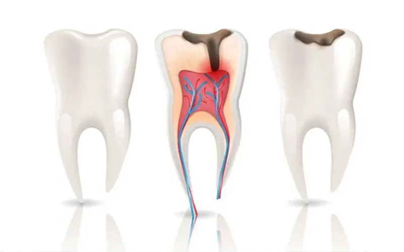Root Canal Treatment in Turkey 3 Root Canal Treatment in Turkey