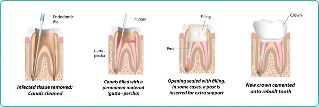 Root Canal Treatment in Turkey 2 Root Canal Treatment in Turkey