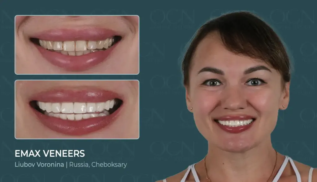 Get Teeth Done in Turkey 9 Emax Veneers - Before & After