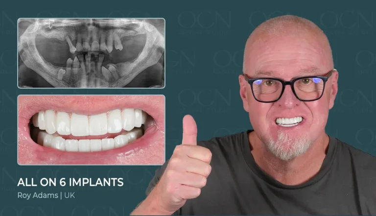 All on 6 Implant - Before & After