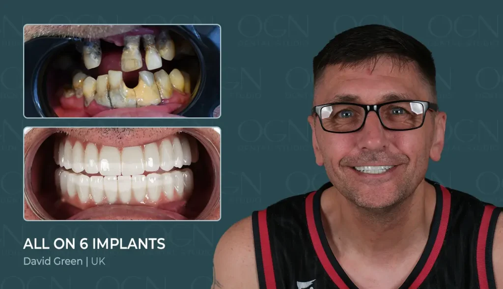 All on 6 Implant - Before & After
