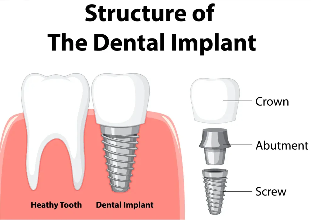 Do Implant Teeth Look Natural? 3 Implant Teeth Look Natural