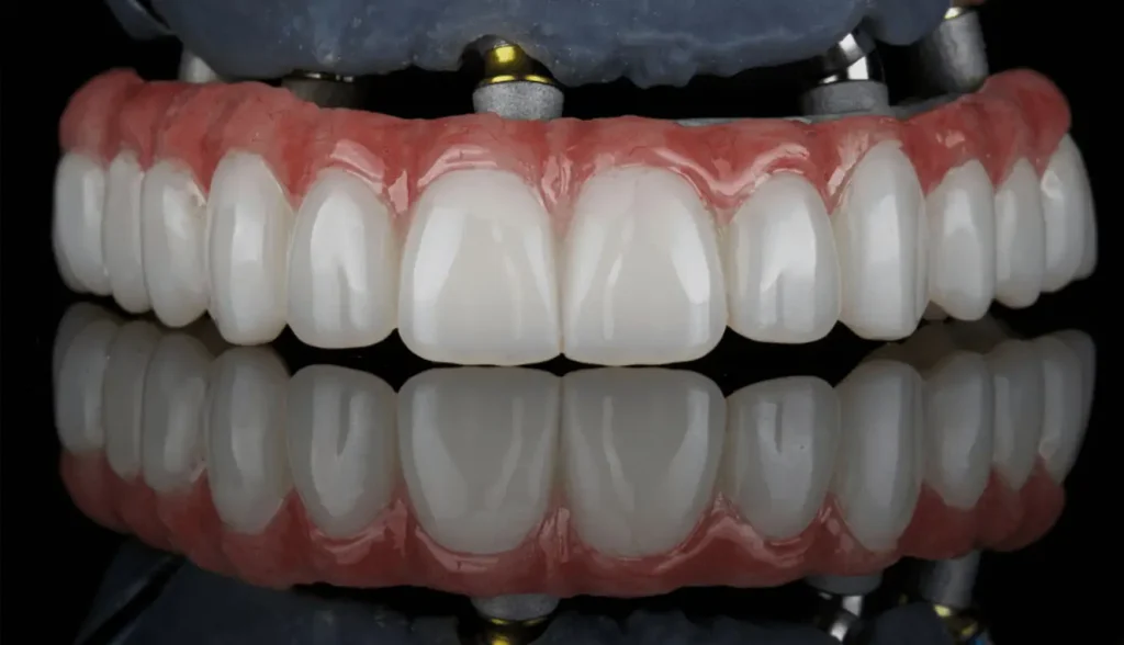 How many implants are needed for the upper jaw? 6 Upper Jaw Dental Implants