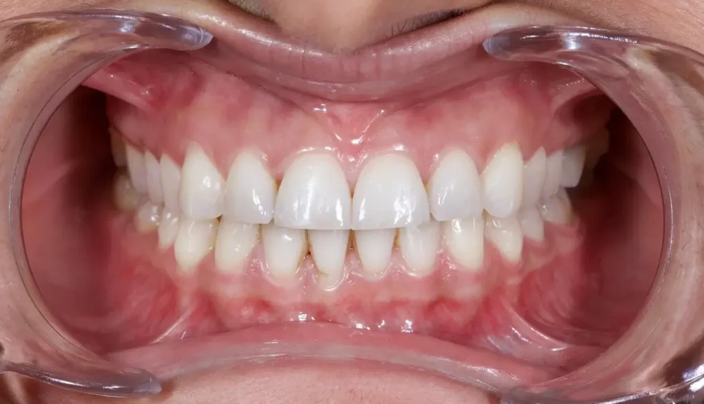How many implants are needed for the upper jaw? 3 Upper Jaw Dental Implants
