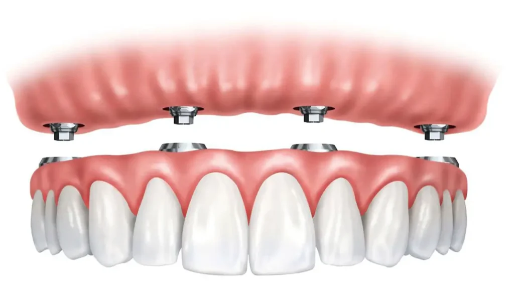 How many implants are needed for the upper jaw? 2 Upper Jaw Dental Implants