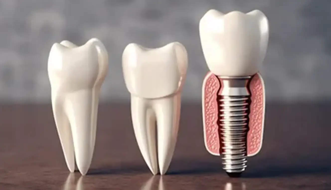 Upper Jaw Dental Implants