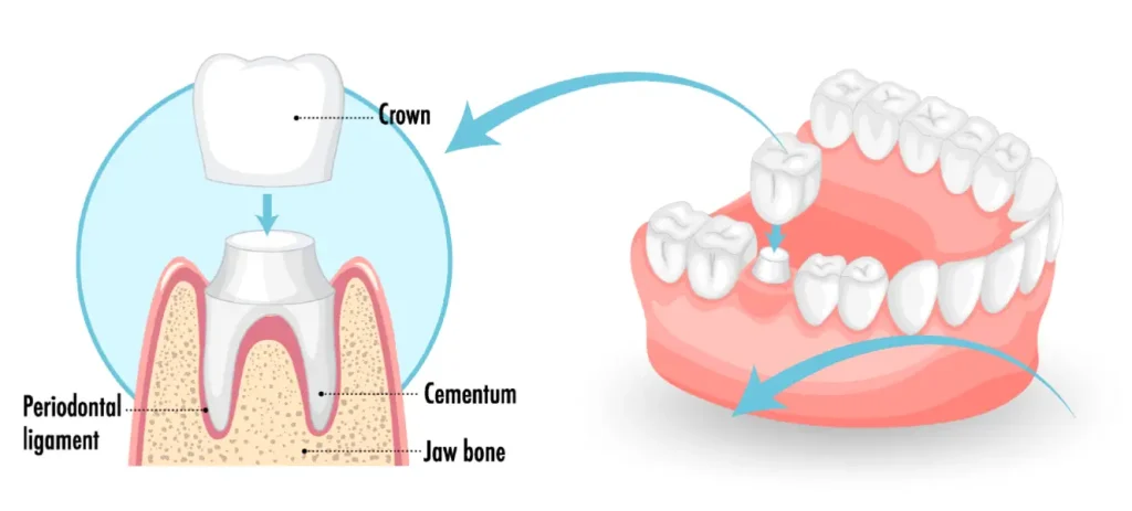 Do Zirconium Crowns Stain? 2 Zirconium Crowns