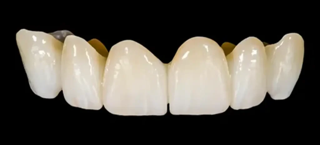 Do Zirconium Crowns Stain? 1 Zirconium Crowns