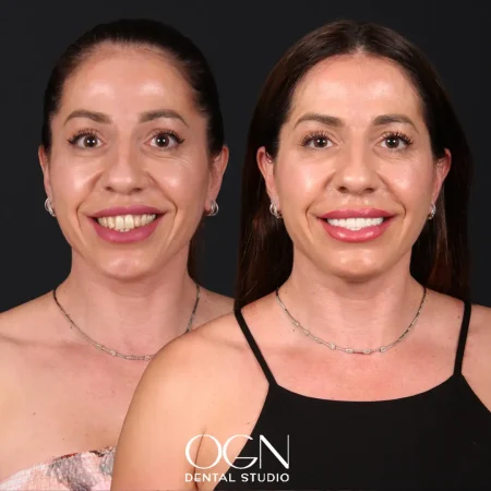 ogn-dental-before-after-10.webp