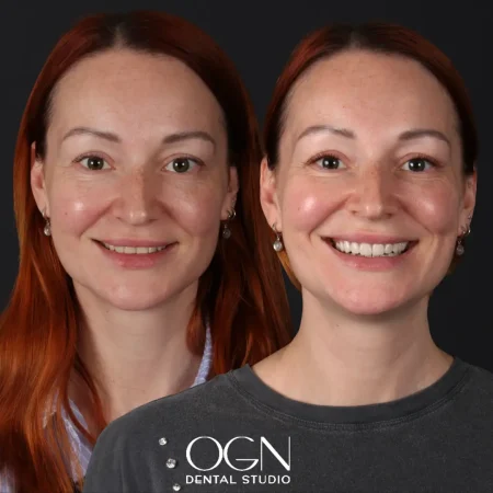 Before & After - OGN Dental - Antalya, Turkey