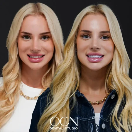 ogn-dental-before-after-8.webp